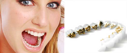 Incognito Lingual Braces