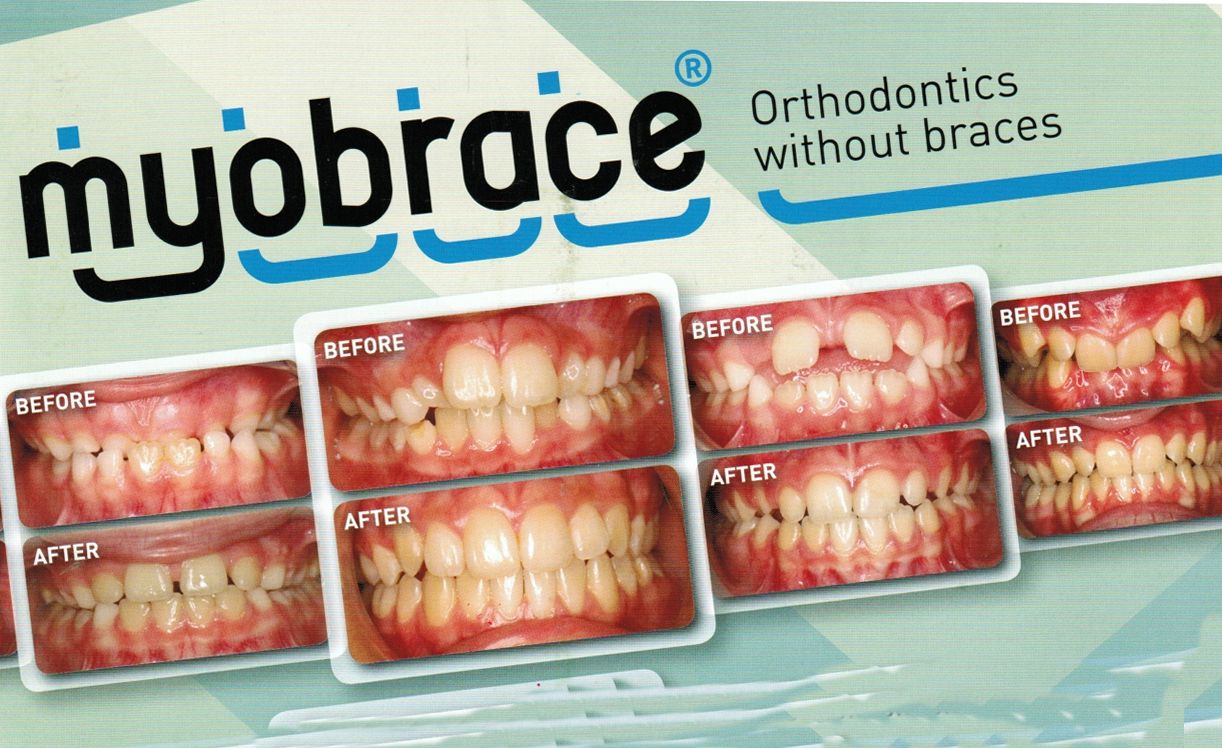 Myobrace
